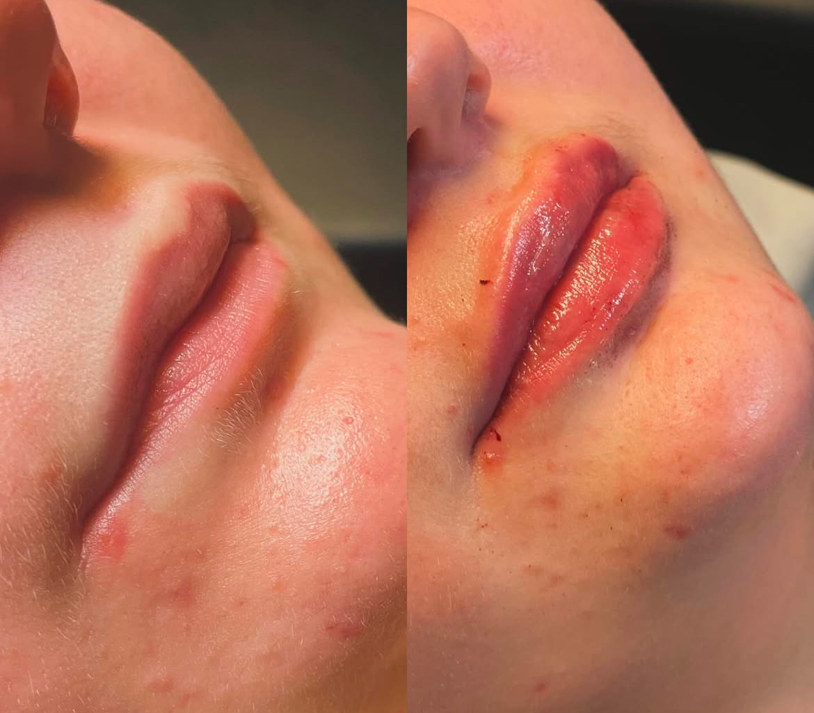 Huulissa kokonaisuudessaan 1ml täyteainetta